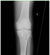 ACL Reconstruction, Dr. Luhmann, Washington University Orthopedics, St. Louis Children's Hospital