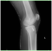 ACL Reconstruction, Dr. Luhmann, Washington University Orthopedics, St. Louis Children's Hospital
