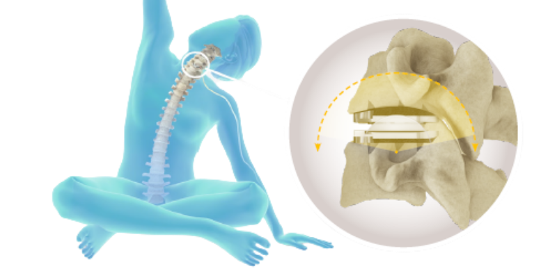 Medical illustration of total disc replacement surgery showing an artificial disc placed between vertebrae to preserve spinal motion.