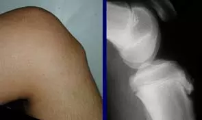 Osgood-Schlatter's Disease Osgood-Schlatter's Disease