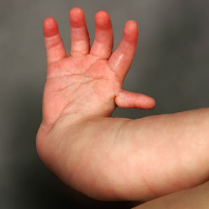 Radial Longitundinal Deficiency