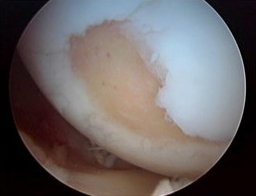 Cartilage defect